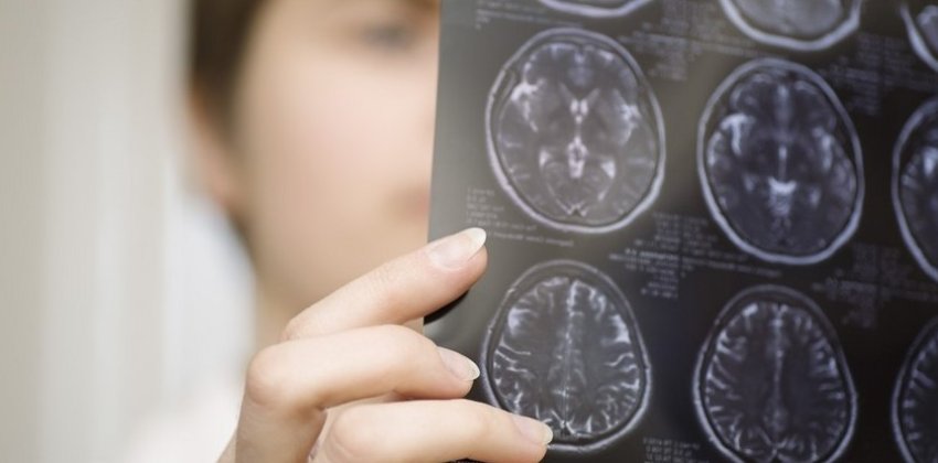 Мифы и заблуждения о раке мозга - «Здоровье»